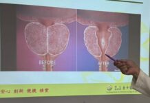 攝護腺體積50公克以下 無傷口微創拉提手術助排尿順暢保雄風